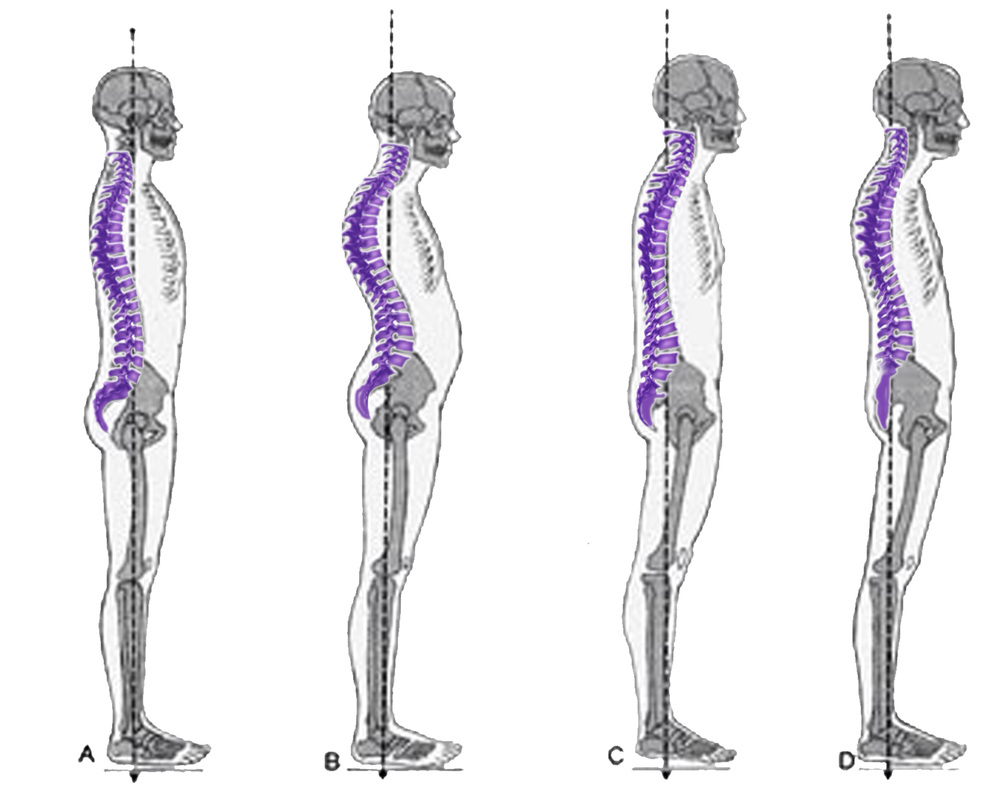 Posture Faqs - Kewin Chiropractic